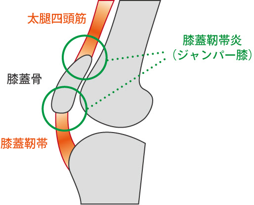 「ジャンパー膝」の画像検索結果