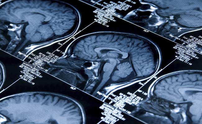 Autopsies Show Covid Virus Lingers In Brain For Months: Study