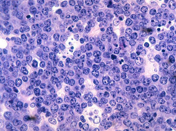 Cancerous B cells in Burkitt lymphoma