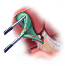 Illustration of laparoscopic gallbladder removal
