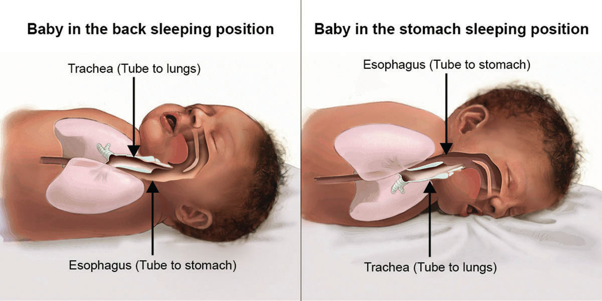 Illustration of baby in the back sleeping position with the trachea (tube to lungs) located above the esophagus (tube to stomach). Illustration of baby in the stomach sleeping position with the esophagus located above the trachea.
