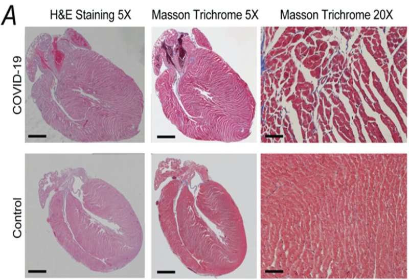 How COVID-19 can impact the heart