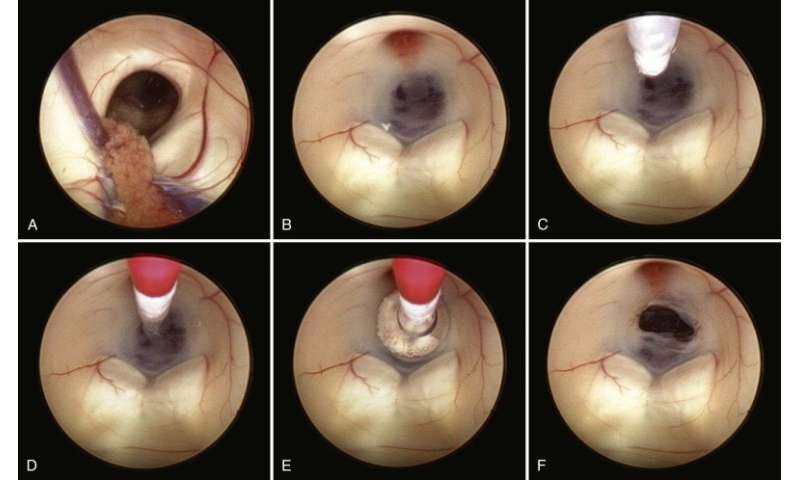 Exploring an unsung part of the brain: the choroid plexus