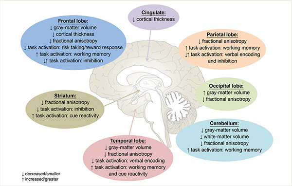 Brain regions affected by alcohol use in adolescence 