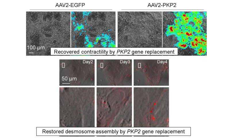 Patient-derived heart cells mimic disease in vitro