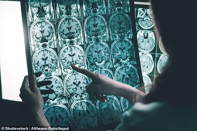 Cambridge University scientists along with a team in Sweden have discovered a new way to target the toxic particles that destroy healthy brain cells (stock)