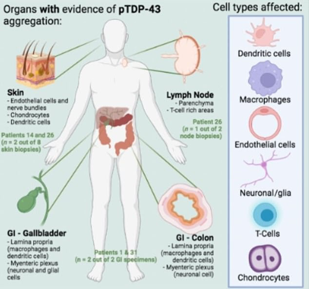 Researchers at the University of Aberdeen studied samples from around a dozen patients who suffered from the rare condition that damages the brain and nerves. They found that half of patients had markers of the disease in biopsies up to 14 years before they developed telltale gripping, walking and speaking difficulties. The results show six patients had the protein in their digestive system, lymph nodes or skin