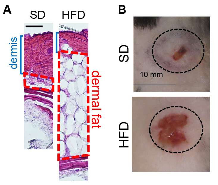 Research identifies obesity and infection link, as well as treatment found on healthy human skin