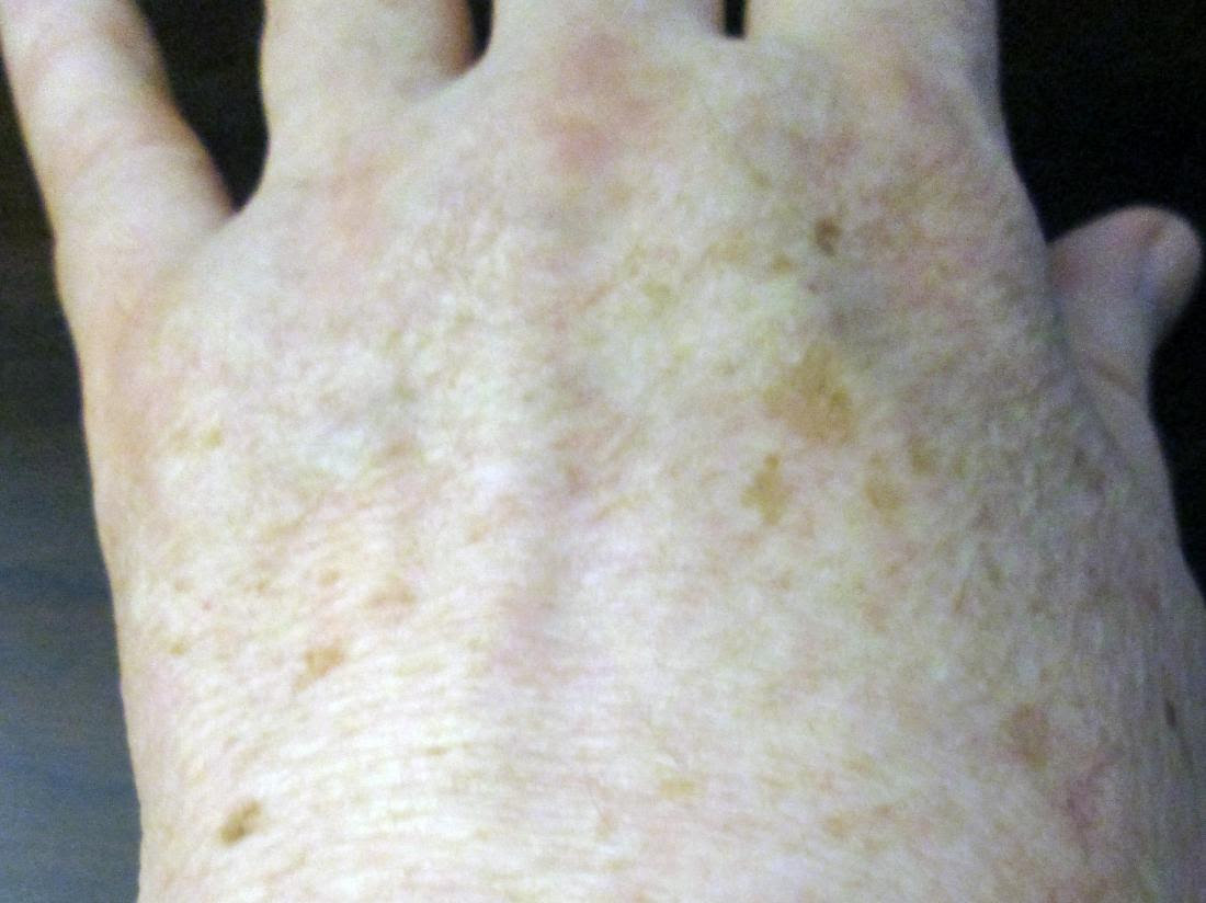 pigmentation on a hand before home remedies. Image credit: Beyond My Ken, 2018