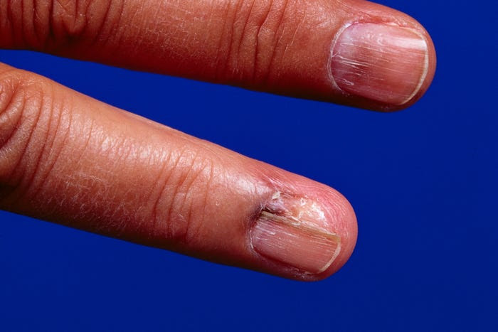 Malignant melanoma of nail.