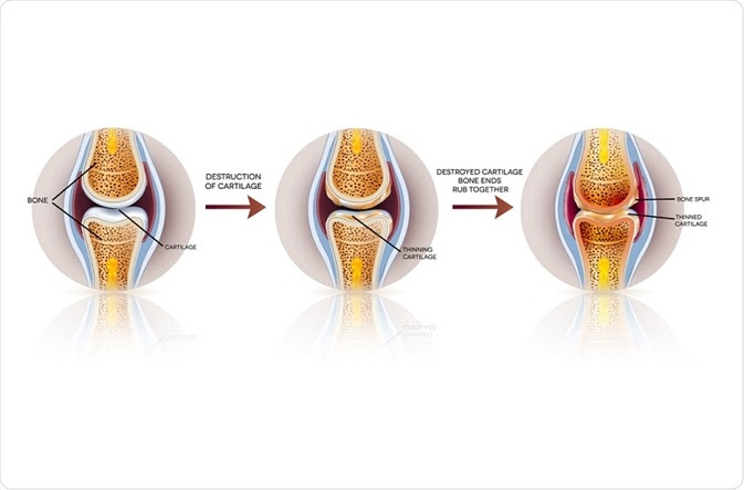 Diagram showing passage of time in osteoarthritis of the knee: healthy to diseased state.