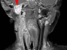 MRI images of a child with infantile fibrosarcoma.