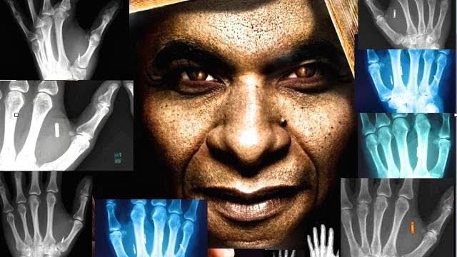Millions Already Chipped: RFID 666 Implant Done Without Obamacare! Millions Already Chipped: RFID 666 Implant Done Without Obamacare!
