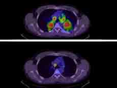 Scan showing tumor shrinkage in lungs.