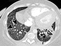 COVID-19 causou edema pulmonar em uma mulher de 50 anos com história de doença renal em estágio terminal que foi submetida a hemodiálise e que deu entrada no hospital por hipóxia e pneumonia.  A TC de tórax com contraste axial obtida após 1 mês para hipoxemia persistente mostra edema pulmonar, aumentando pequenos derrames pleurais bilaterais, cardiomegalia, septal interlobular proeminente (pontas de seta) e espessamento peribroncovascular (seta) e opacidades em vidro fosco difusas.  Edema pulmonar sobreposto ao COVID