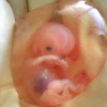 638px-Human_fetus_10_weeks_with_amniotic_sac_-_therapeutic_abortion