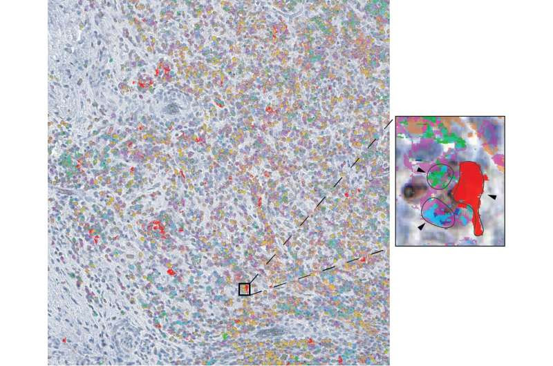 Study reveals a trio of immune cells vital in response to liver cancer immunotherapy