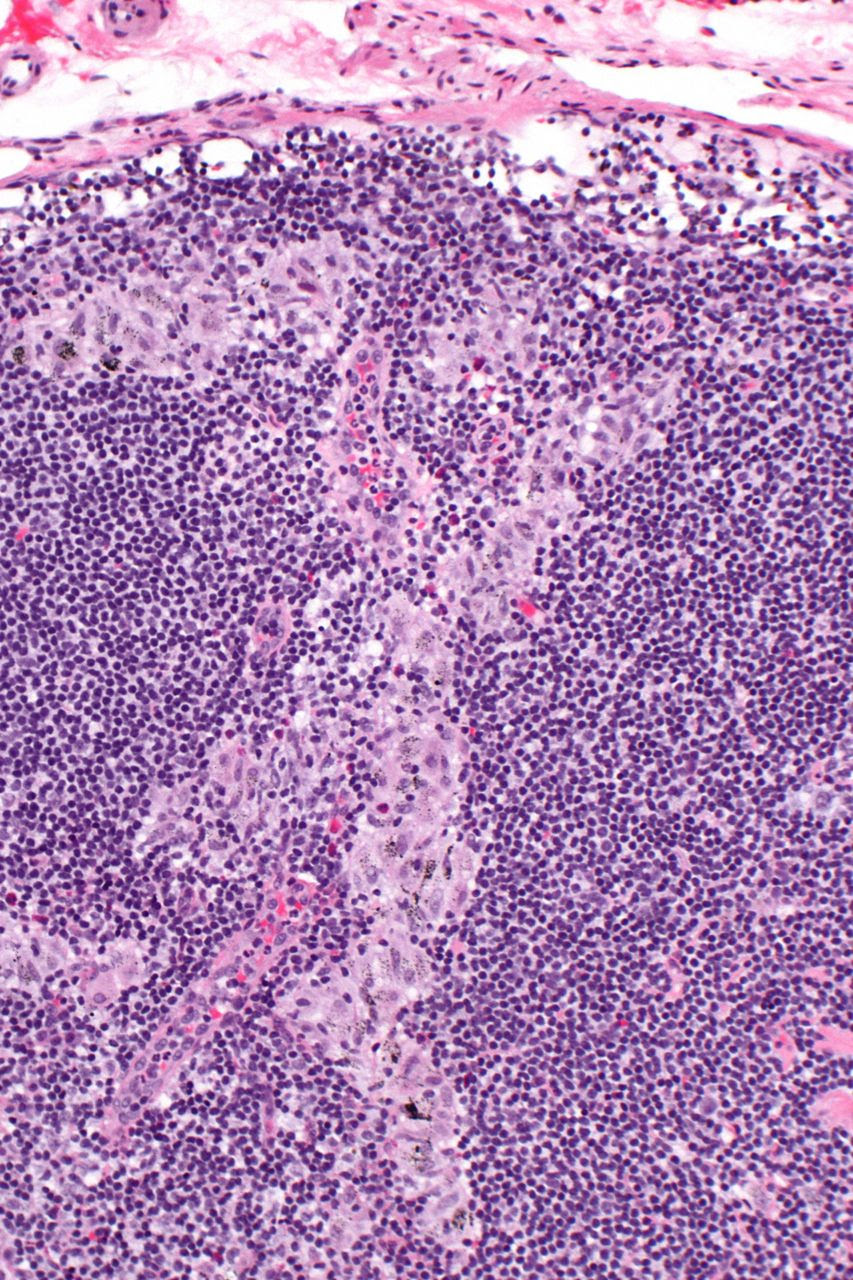 pathobiology-red-vs-white-infarcts