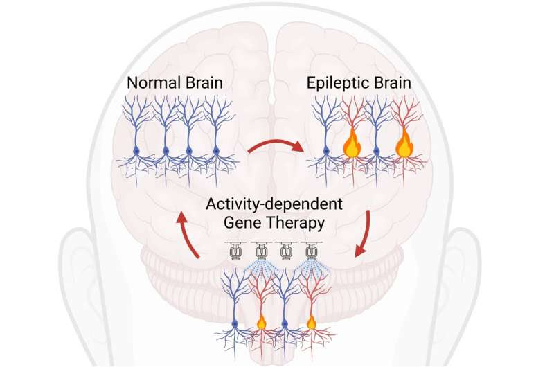 Gene therapy targeting overactive brain cells could treat neurological disorders