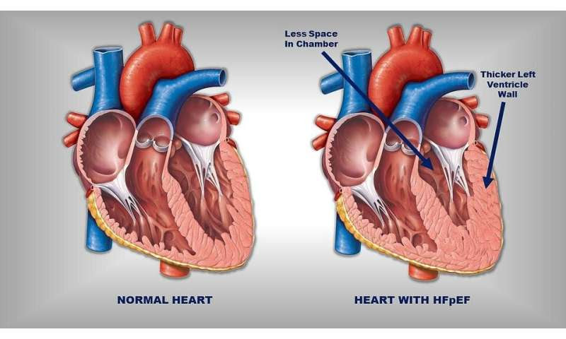 Obesity weakens heart muscle in patients with a common type of heart failure