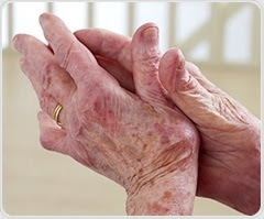 Women with rheumatoid arthritis suffer greater decline in physical function after menopause