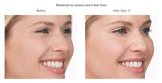 Botox B&A