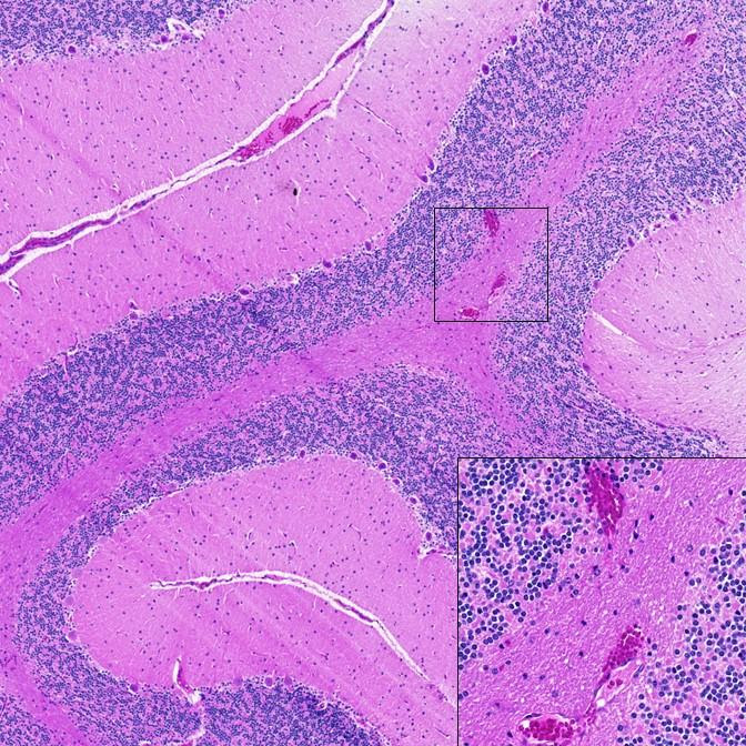 An increase in the number of brain microhemorrhages is observed with SARS-CoV-2 infection, as depicted here in cerebellum from an infected African green monkey