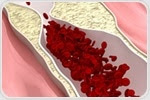 Researchers show novel relationship between gut microbiome and atherosclerosis