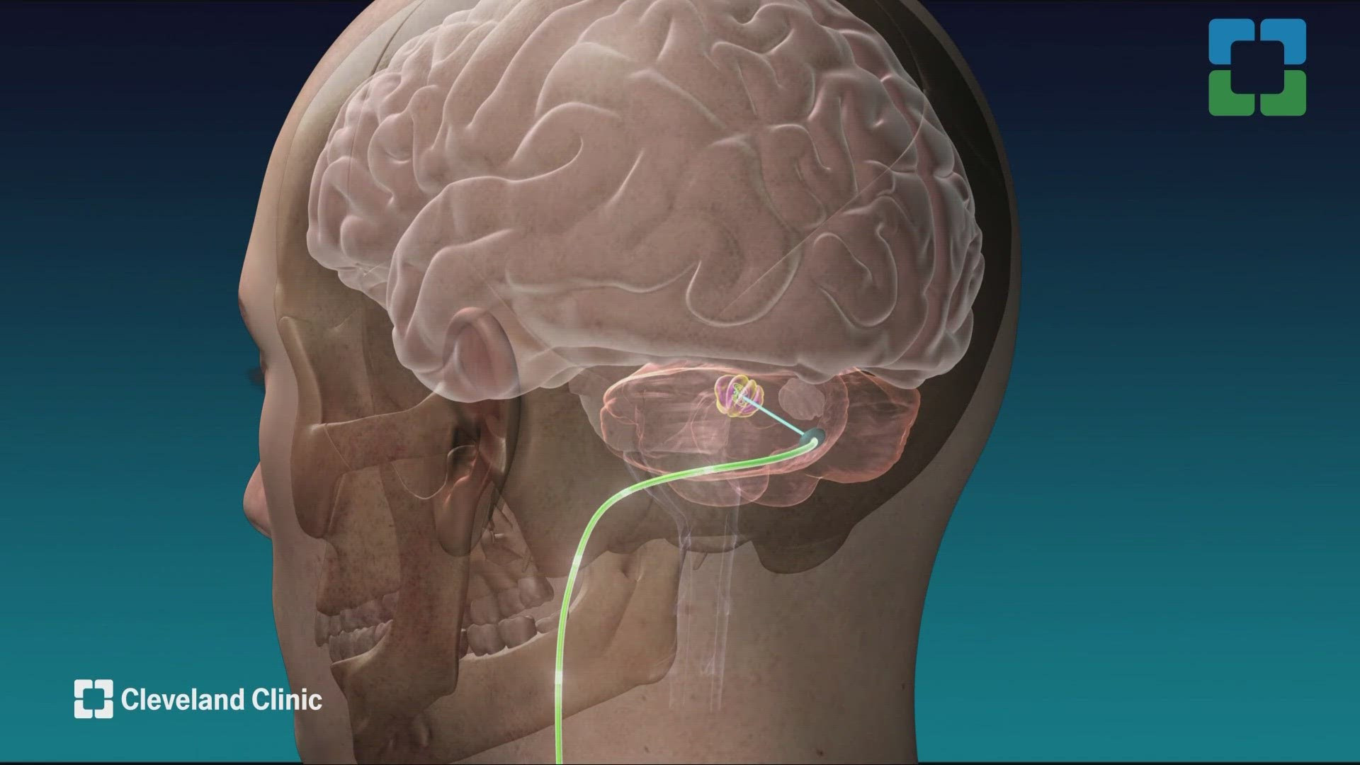 Deep brain stimulation study for stroke paralysis