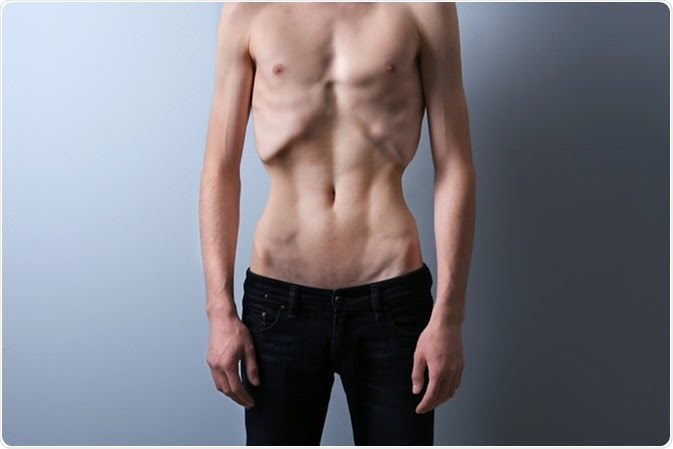 Male with anorexia. Image Credit: Africa Studio / Shutterstock