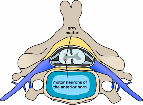 motor neurone disease