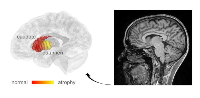 Diagnosis of early-stage Parkinson's disease now possible with new method developed at Hebrew University