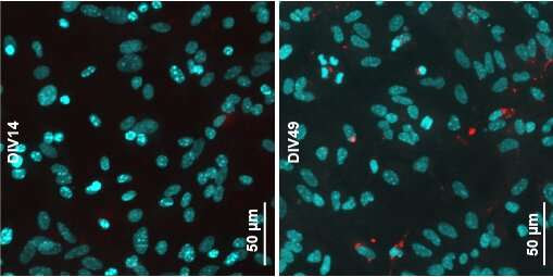 Discovery illuminates how Parkinson's disease spreads in the brain