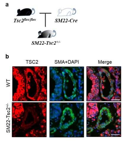 Pulmonary arterial hypertension is incurable but animal model study suggests an experimental drug may be effective