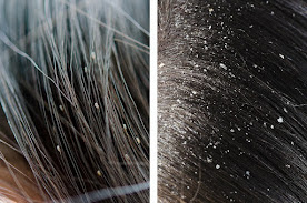 dandruff