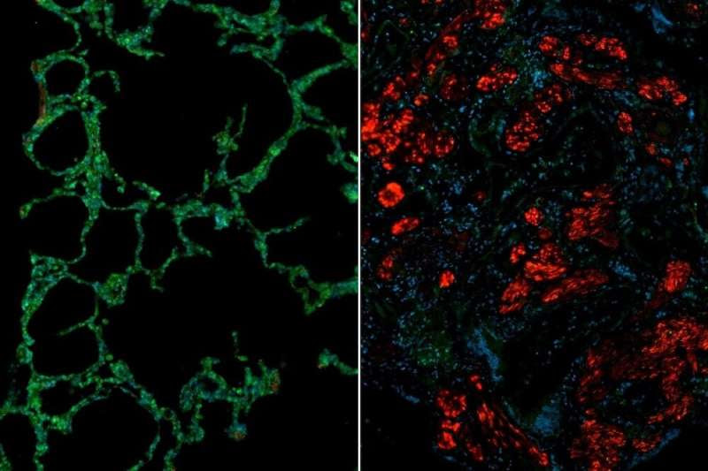 Balancing act: Reversing lung fibrosis in scleroderma requires an increase in antifibrotic proteins