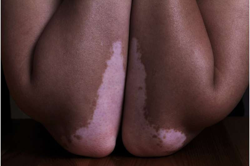 vitiligo