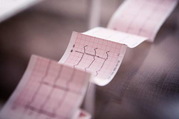 Cardiograma médico impreso en papel. 