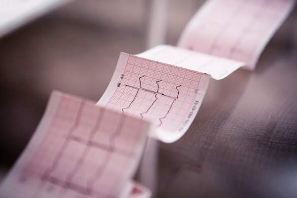 Cardiograma médico impreso en papel.