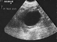 Over kistinin ultrasondan görünümü