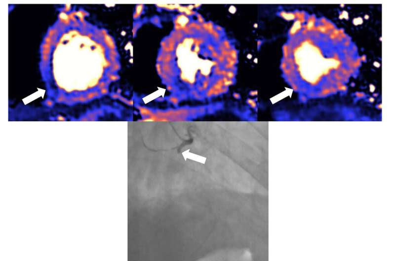 Damage to the heart found in more than half of COVID-19 patients discharged from hospital