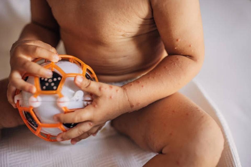 Child with Hand, Foot, and Mouth Disease with a Visible Rash