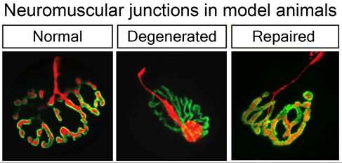 Researchers from Tel Aviv University identified the biological mechanism causing nerve destruction in the Motor Neuron disease A