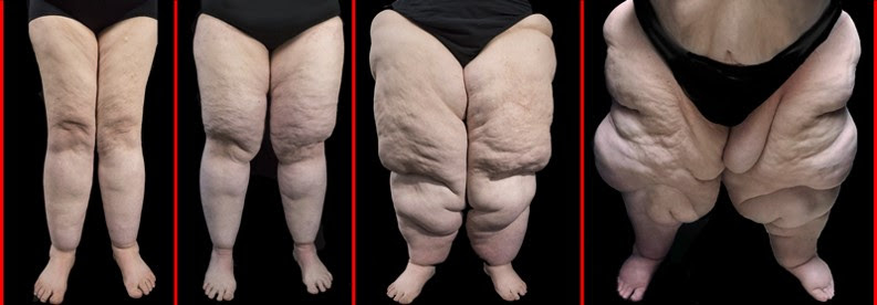 Lipedema X Linfedema – Dra Thaís Vascular