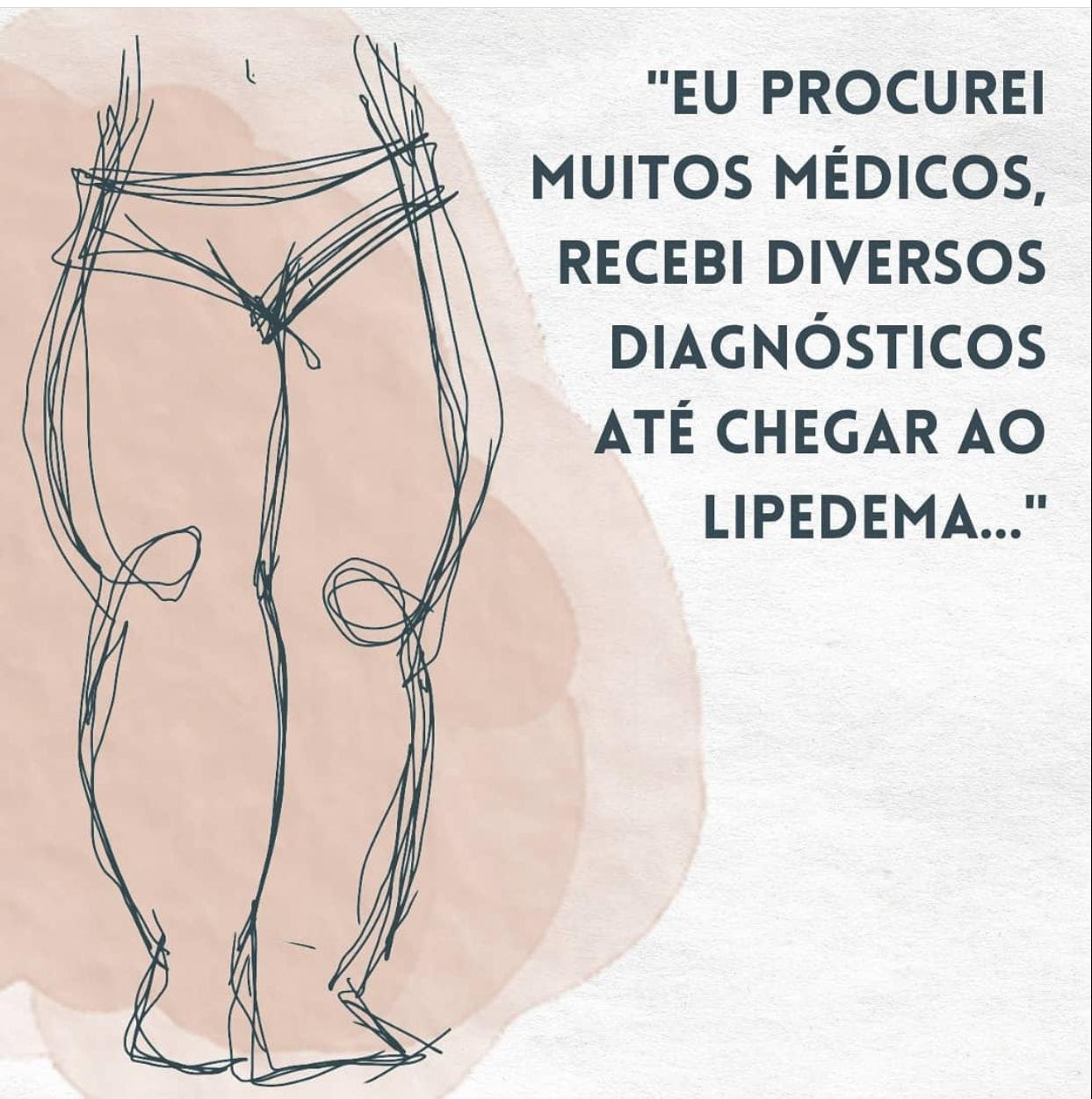 O lipedema é uma inflamação de baixo grau do tecido gorduroso. Lipedema não  é gordura.