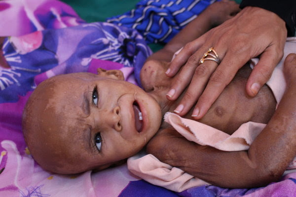I took this photo of a starving child on a visit to a malnutrition ward in Aden, Yemen, late last year.