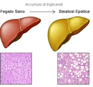 Steatosi Epatica