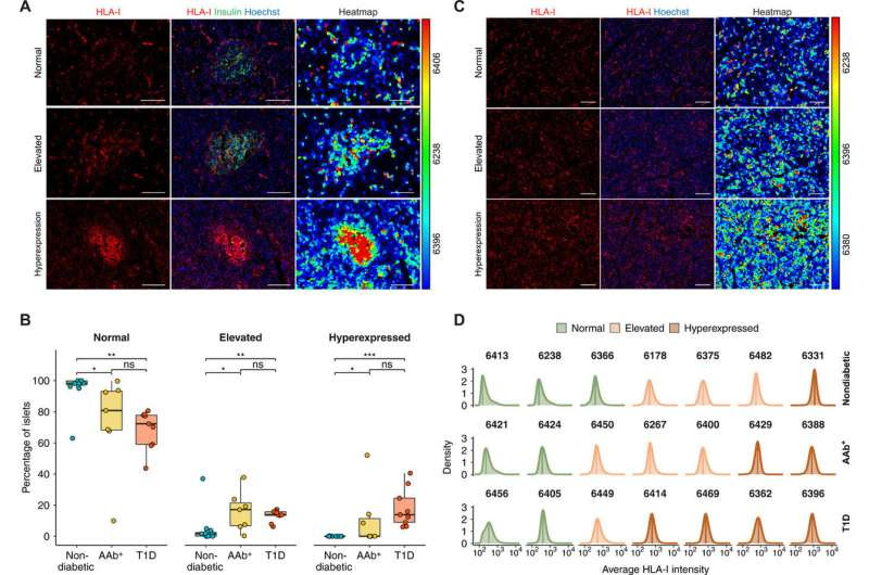 Relationship between type 1 diabetes, interferon response and viral infection is first step toward preventive therapies