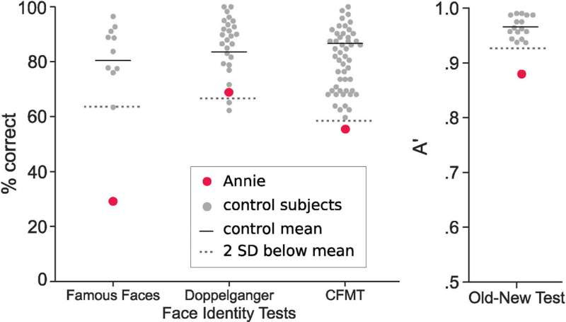 COVID-19 can cause 'face blindness'