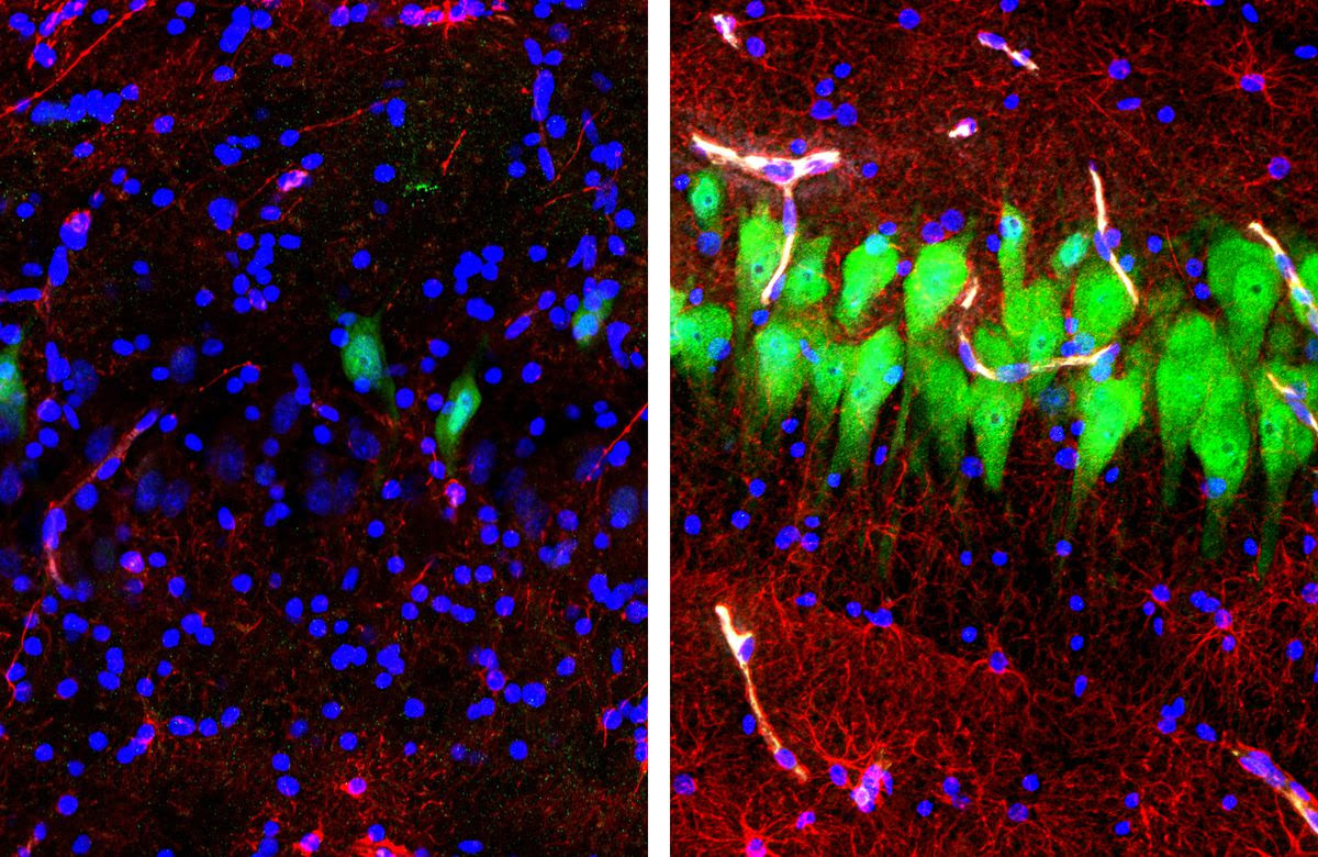 Brain scans showing cell death on one side and live cells on the other.